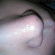 「いちご鼻」薬用ニキビケア【アクネル アクネクリアローション＋AZセラム】を20名様に！の投稿画像