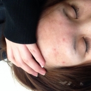 「かすみぃち」薬用ニキビケア【アクネル アクネクリアローション＋AZセラム】を20名様に！の投稿画像