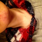 「顎ニキビのプツプツ」薬用ニキビケア【アクネル アクネクリアローション＋AZセラム】を20名様に！の投稿画像