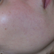 「毛穴です。」薬用ニキビケア【アクネル アクネクリアローション＋AZセラム】を20名様に！の投稿画像