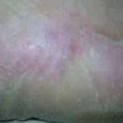 「私の皮膚病」「美かかと名人」貴方のかかとのケアします！体の中からかかとのケア！５名さま募集の投稿画像