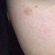 「右目の下のシミ」こんなシミ隠したいです画像募集！デルミサ　レーザーコンシーラーの投稿画像