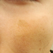 「目の下のシミ」こんなシミ隠したいです画像募集！デルミサ　レーザーコンシーラーの投稿画像