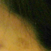 「こめかみと頬に。」こんなシミ隠したいです画像募集！デルミサ　レーザーコンシーラーの投稿画像