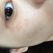 「よろしくお願いします！」こんなシミ隠したいです画像募集！デルミサ　レーザーコンシーラーの投稿画像