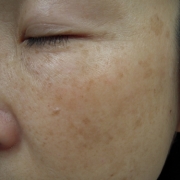 「しみ＆そばかす」こんなシミ隠したいです画像募集！デルミサ　レーザーコンシーラーの投稿画像