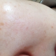 「隠したいモノ」こんなシミ隠したいです画像募集！デルミサ　レーザーコンシーラーの投稿画像