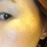 「ポツポツシミをなんとかしたい！」こんなシミ隠したいです画像募集！デルミサ　レーザーコンシーラーの投稿画像