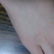 「あらら」こんなシミ隠したいです画像募集！デルミサ　レーザーコンシーラーの投稿画像