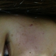 「シミとにきび跡´д` ;」こんなシミ隠したいです画像募集！デルミサ　レーザーコンシーラーの投稿画像