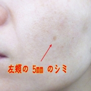 「各所にあるシミ」こんなシミ隠したいです画像募集！デルミサ　レーザーコンシーラーの投稿画像