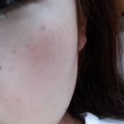 「30代、若い頃のつけ」今年夏発売予定！純ハイドロキノン配合美容液モニター大募集！の投稿画像