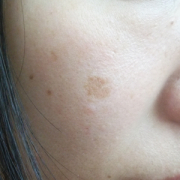 「頬のシミ・・・」今年夏発売予定！純ハイドロキノン配合美容液モニター大募集！の投稿画像