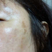 「シミが広がってきました」今年夏発売予定！純ハイドロキノン配合美容液モニター大募集！の投稿画像