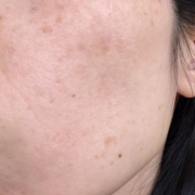 「頬全体のシミ」今年夏発売予定！純ハイドロキノン配合美容液モニター大募集！の投稿画像