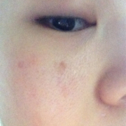 「顔の真ん中にあるシミ」今年夏発売予定！純ハイドロキノン配合美容液モニター大募集！の投稿画像