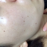 右頬にたくさんシミが&hellip;