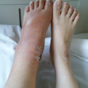 「足、腰弱!!( ￣▽￣)」＜スマホイベント＞痛いのさよなら！Ｎ-アセチルグルコサミン！モニター募集！の投稿画像