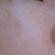 「コエンザイムQ10ってシミなどのトラブルにいいイメージがあります。なので、写真のようなシミ・ソバカスや赤みが少しでも和らいだら嬉しいです(*´ω｀*)コエンザイムQ10で美肌になるぞ！」<スマホイベント>あなたはいくつ当てはまる？活性型コエンザイムＱ１０モニター募集の投稿画像