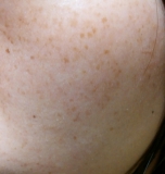 そばかす、しみ