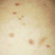 「お腹の火傷」【長期モニター】純ハイドロキノン2.0％配合！デルミサスキンフェイドクリーム の投稿画像