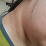 「首の黒ずみ」【長期モニター】純ハイドロキノン2.0％配合！デルミサスキンフェイドクリーム の投稿画像