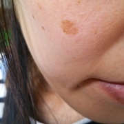 「頬のシミ」【長期モニター】純ハイドロキノン2.0％配合！デルミサスキンフェイドクリーム の投稿画像