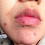 「どーしたものか。」【長期モニター】純ハイドロキノン2.0％配合！デルミサスキンフェイドクリーム の投稿画像