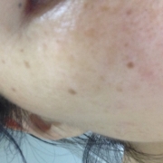 「消したい」【長期モニター】純ハイドロキノン2.0％配合！デルミサスキンフェイドクリーム の投稿画像