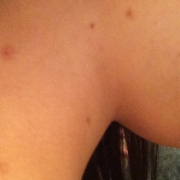 「ほくろの薄い感じ。。」【長期モニター】純ハイドロキノン2.0％配合！デルミサスキンフェイドクリーム の投稿画像