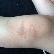 「数々のシミ、怪我の跡」【長期モニター】純ハイドロキノン2.0％配合！デルミサスキンフェイドクリーム の投稿画像