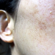 「何をつけても効果がない(>_<)」【長期モニター】純ハイドロキノン2.0％配合！デルミサスキンフェイドクリーム の投稿画像