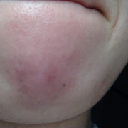 「恥ずかしい」長期モニター募集！女のヒゲに眉毛に！フランス発の顔用抑毛美容液！の投稿画像