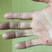 「手のひらだけでなく顔や首もボロボロです。」<アトピーでお悩みの方>ブログ不要！！あなたを長期サポート☆夢を応援します☆の投稿画像