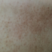 「痒みが体の全体に…」<アトピーでお悩みの方>ブログ不要！！あなたを長期サポート☆夢を応援します☆の投稿画像