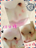 「ニキビ美容液を使用して」の画像（1枚目）