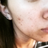 頑固なニキビ跡・・・