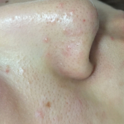 「ニキビと毛穴」薬用ニキビケア【アクネル アクネクリアローション＋AZセラム】を20名様に！の投稿画像