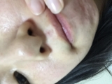 現在は鼻の上、下、アゴのニキビができています