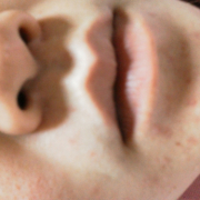 「ニキビやニキビ痕が酷いです。」薬用ニキビケア【アクネル アクネクリアローション＋AZセラム】を20名様に！の投稿画像