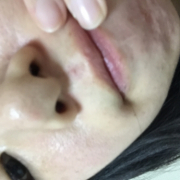 「現在は鼻の上、下、アゴのニキビができています」薬用ニキビケア【アクネル アクネクリアローション＋AZセラム】を20名様に！の投稿画像