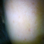 「このようなニキビ跡がたくさん」薬用ニキビケア【アクネル アクネクリアローション＋AZセラム】を20名様に！の投稿画像