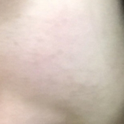 「ニキビ」薬用ニキビケア【アクネル アクネクリアローション＋AZセラム】を20名様に！の投稿画像