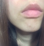 「ニキビ跡が出来やすい私の救世主！」の画像（1枚目）