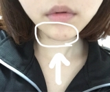 ニキビ跡用美容液（＾&nu;＾）