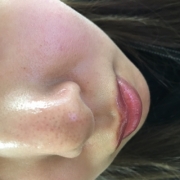 「黒ずみが・・」鼻の角栓にお悩みの方限定♪美容オリーブオイルで『いちご鼻ケア』♪の投稿画像