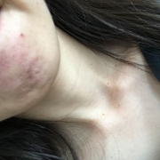 「あごにきびが悩み」【モニター20名様！】新発売！あごニキビに悩む方へのCCクリーム5000円相当の投稿画像