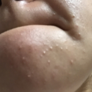 「ニキビで悩んでる部品、手の甲、顔です」【モニター20名様！】新発売！あごニキビに悩む方へのCCクリーム5000円相当の投稿画像