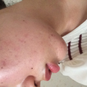 「20歳を過ぎた頃」【モニター20名様！】新発売！あごニキビに悩む方へのCCクリーム5000円相当の投稿画像