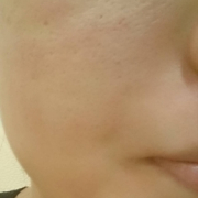 「顔出しＯＫです！ 　」【モニター20名様！】新発売！あごニキビに悩む方へのCCクリーム5000円相当の投稿画像